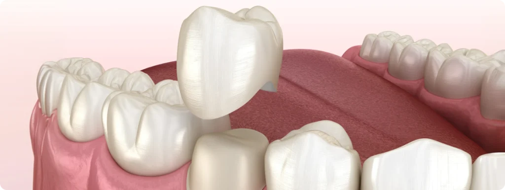 Couronnes dentaires SNT, Dentistes à Vaires-sur-Marne