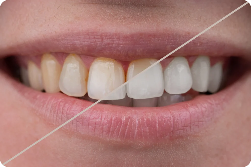 eclaircissement dentaire sourire vaires sur marne Éclaircissement dentaire SNT, Dentistes à Vaires-sur-Marne