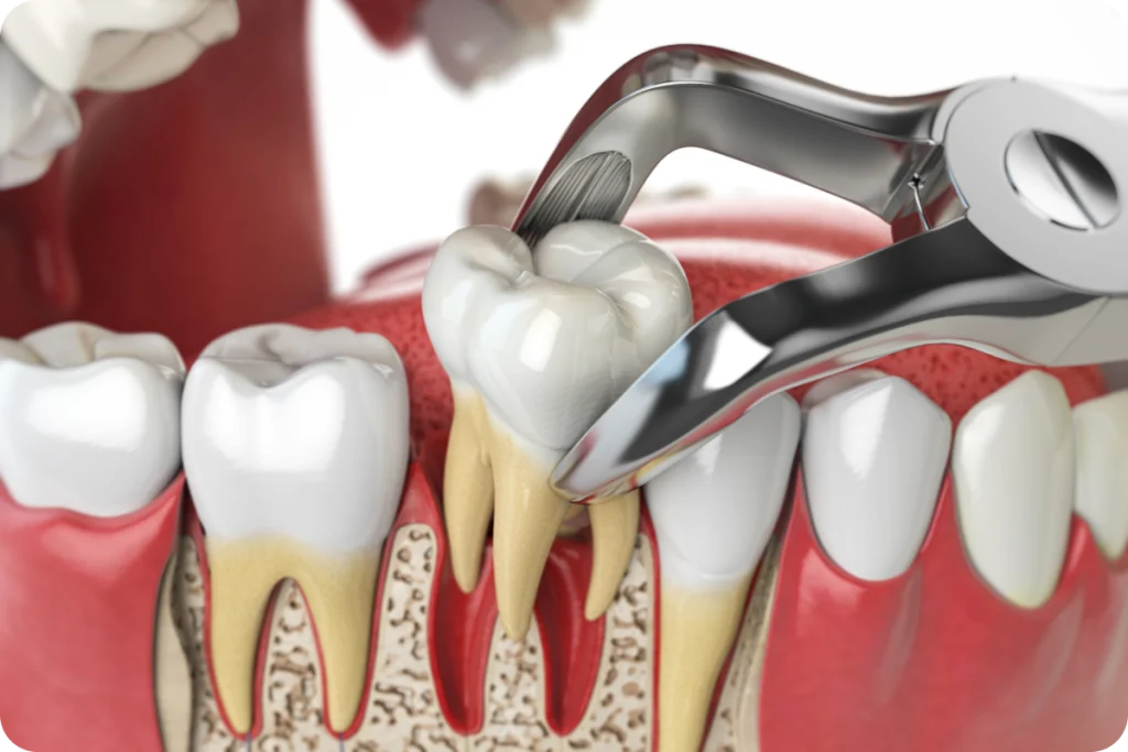 Extraction de dents SNT, Dentistes à Vaires-sur-Marne
