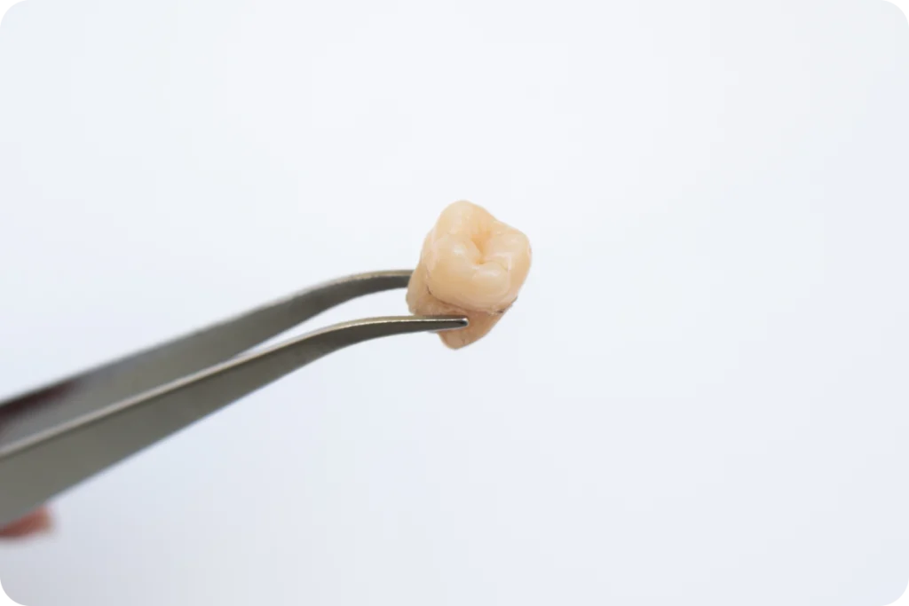 Extraction de dents SNT, Dentistes à Vaires-sur-Marne