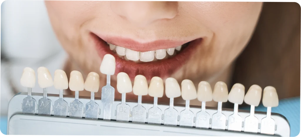 facettes dentaire email vaires sur marne Facettes dentaires SNT, Dentistes à Vaires-sur-Marne