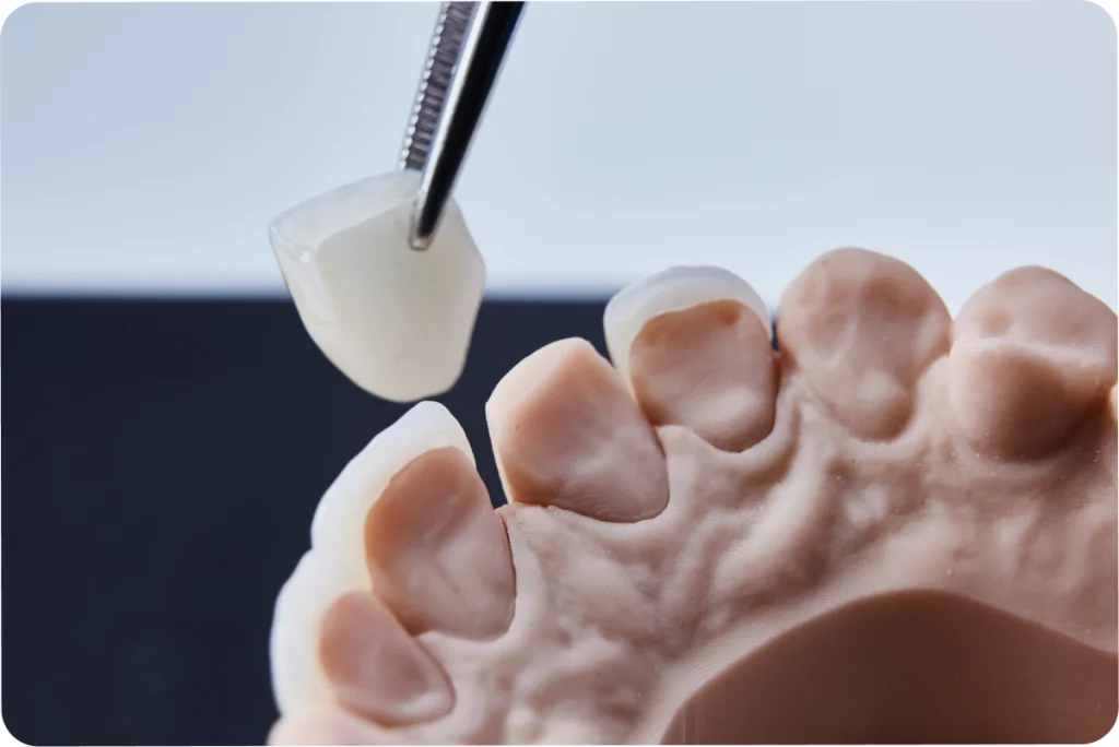 facettes dentaire teinte vaires sur marne Facettes dentaires SNT, Dentistes à Vaires-sur-Marne