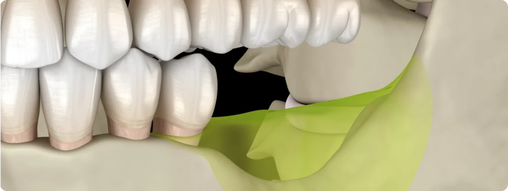 Greffe osseuse SNT, Dentistes à Vaires-sur-Marne
