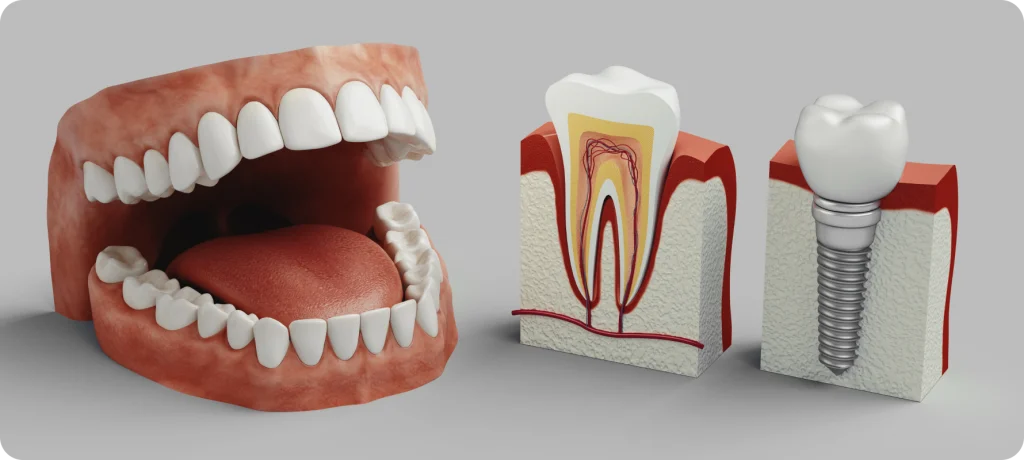 implant dentaire cicatrisation vaires sur marne Implant dentaire SNT, Dentistes à Vaires-sur-Marne