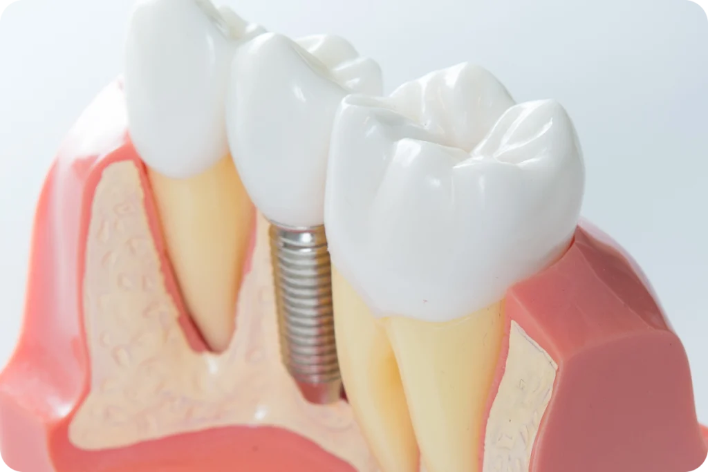 implant dentaire vaires sur marne snt Implant dentaire SNT, Dentistes à Vaires-sur-Marne
