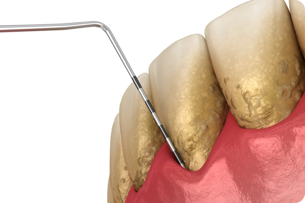 maladies gencives signes alertes Traitement des maladies des gencives SNT, Dentistes à Vaires-sur-Marne