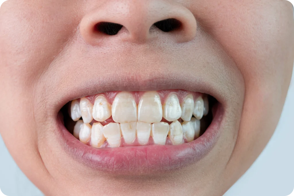 taches dentaires traitement vaires sur marne Traitement esthétique des taches dentaires SNT, Dentistes à Vaires-sur-Marne