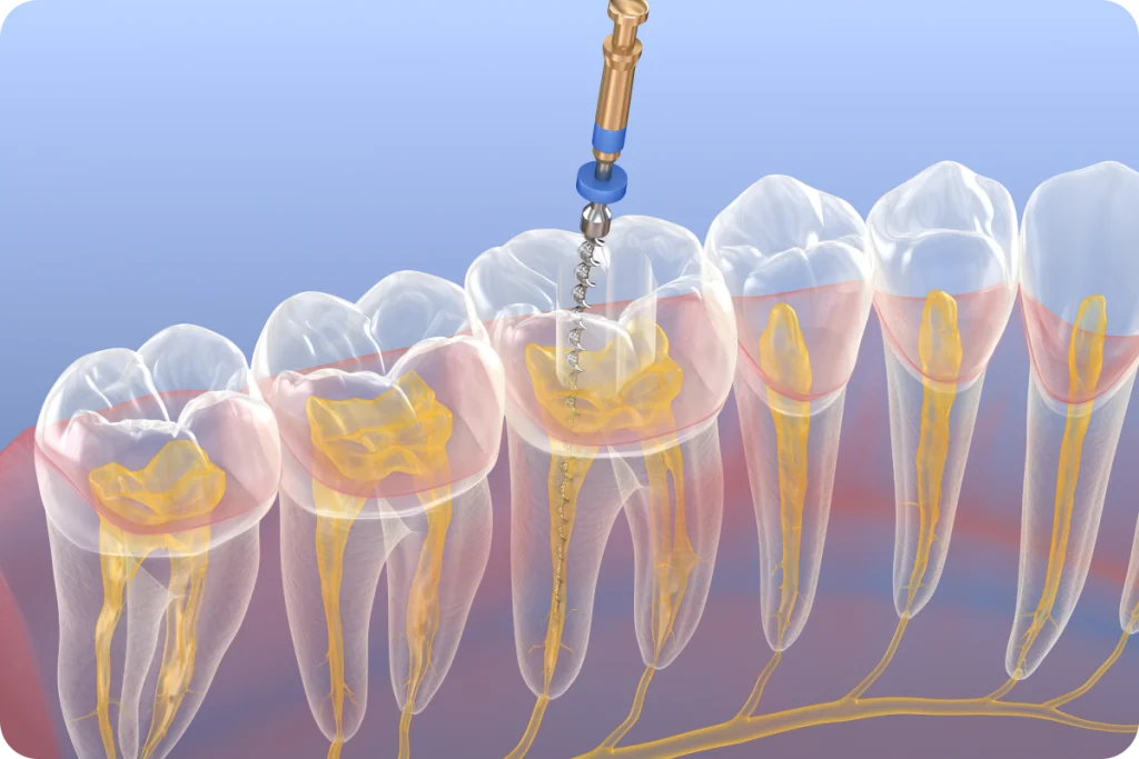 traitement endodontique preservation vaires sur marne Traitement endodontique SNT, Dentistes à Vaires-sur-Marne
