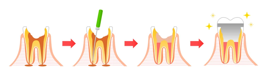 traitement endodontique vaires sur marne x Traitement endodontique SNT, Dentistes à Vaires-sur-Marne